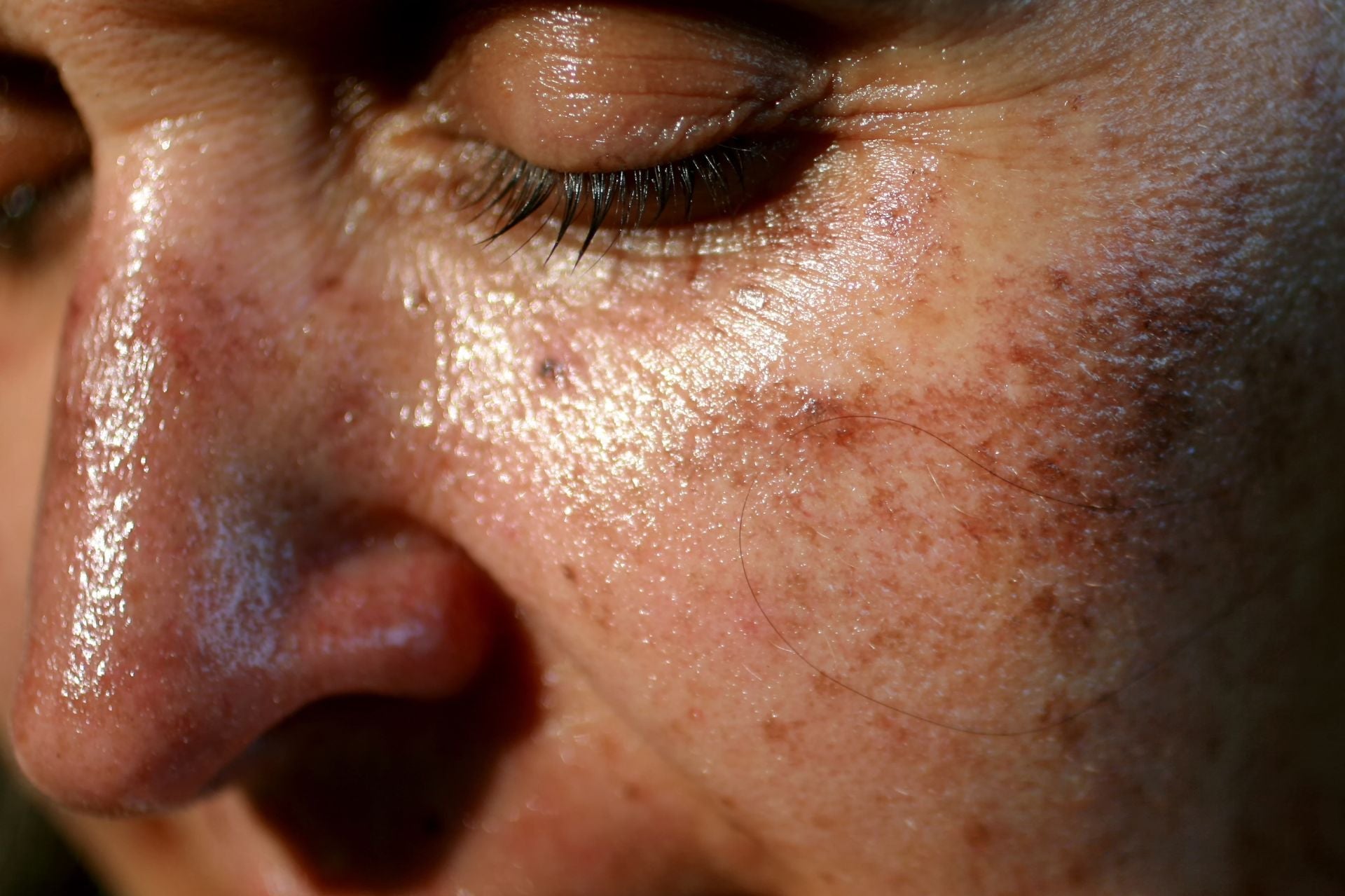 woman with Sun spots 