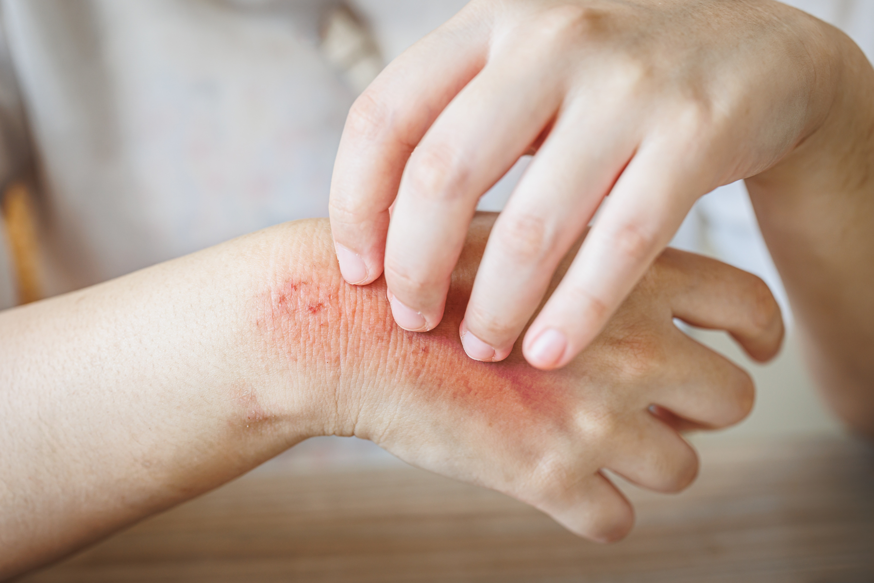 Eczema